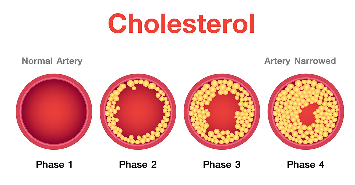 عوامل ایجاد کلسترول بالا در بدن چیست؟